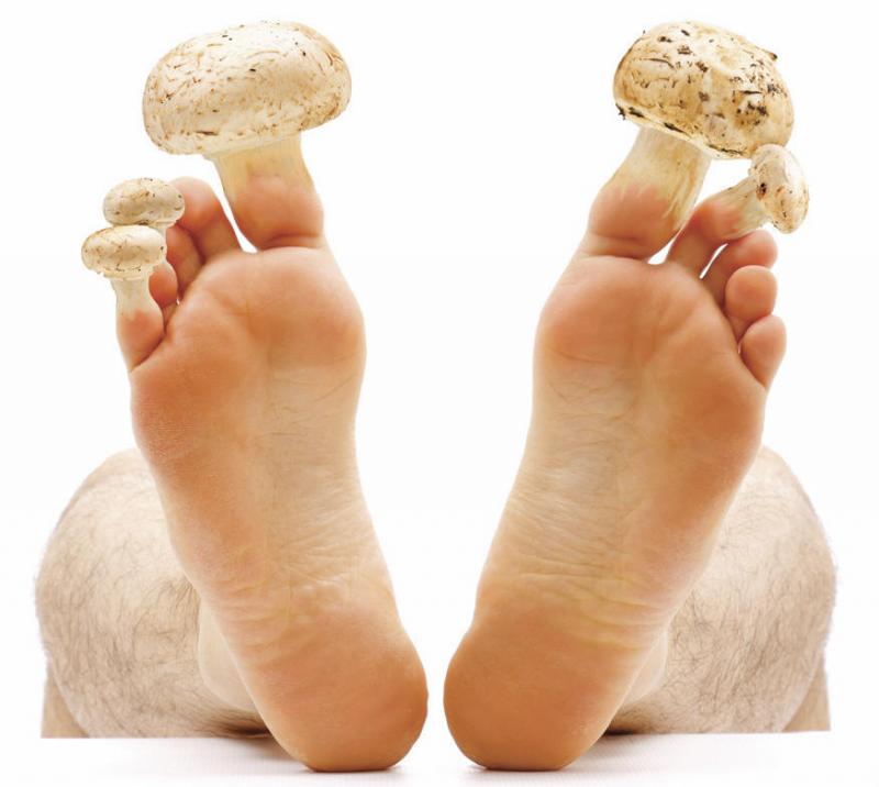 Лечение грибка ногтей на ногах народными средствами