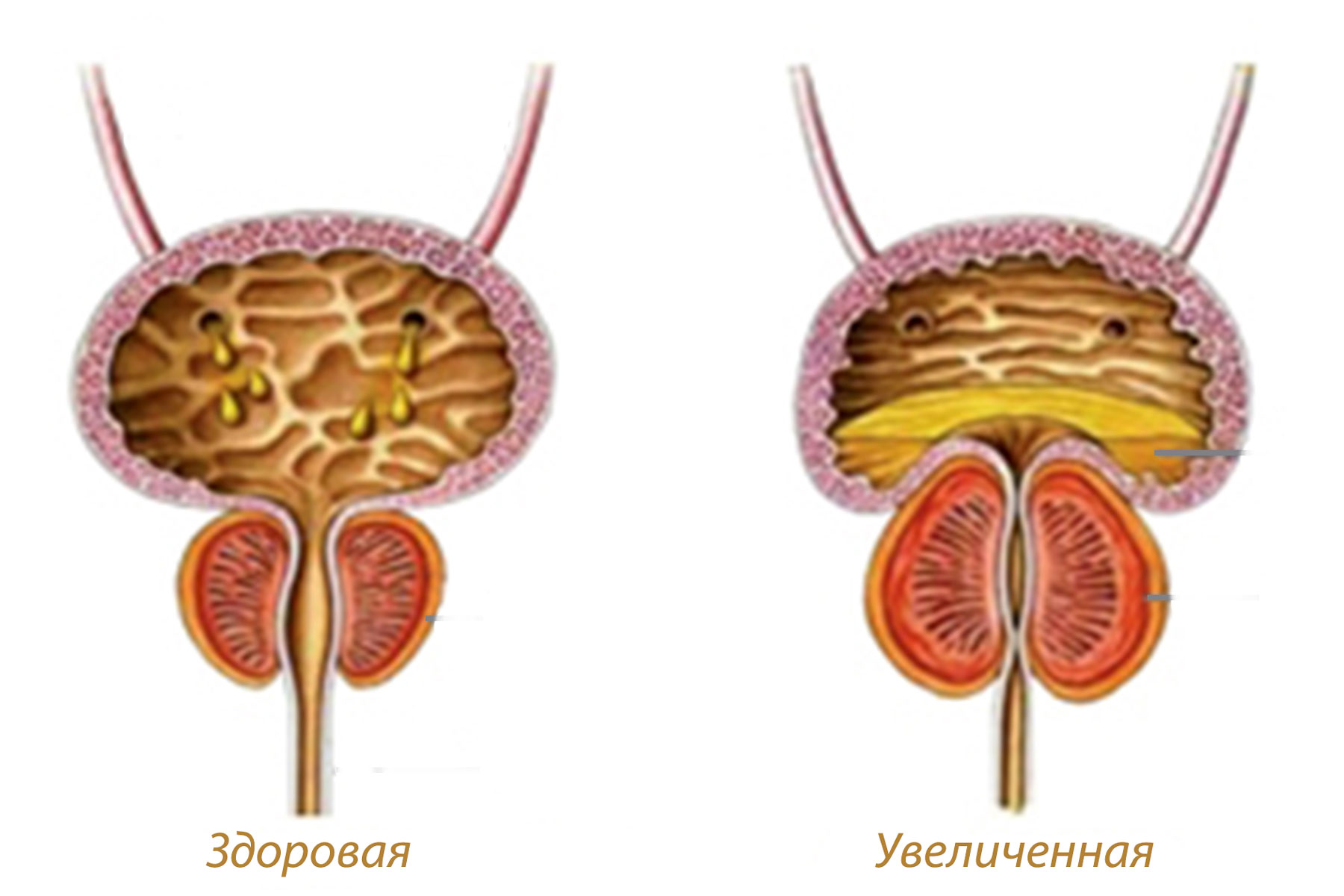 Простата это предстательная. Предстательная железа аденома простаты. Аденома простаты симптомы. Доброкачественная гиперплазия предстательной железы.