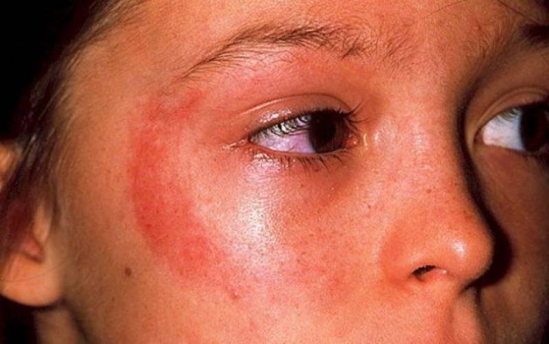 Аллергия на солнце – фотодерматит