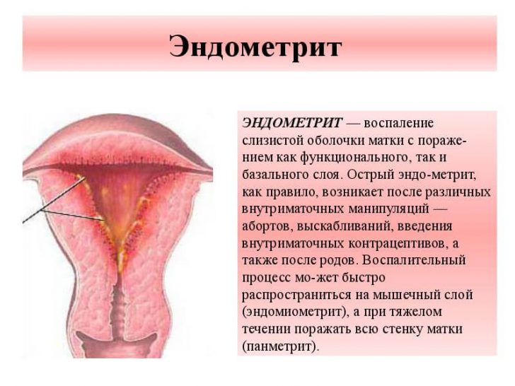 endometrit