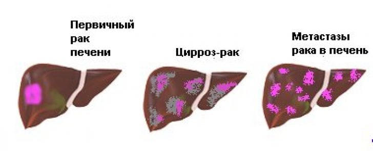 Рак печени 4 стадии сколько живут
