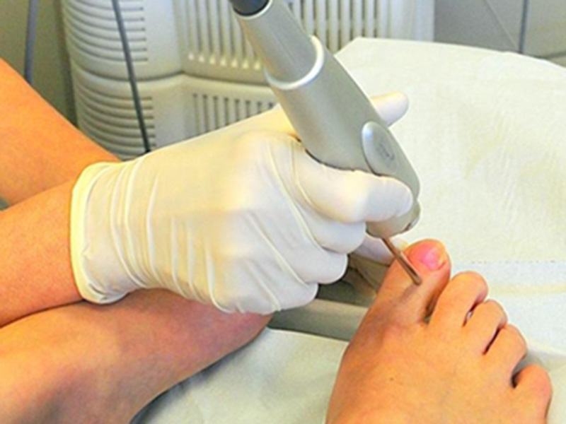 Современные методы лечения грибка ногтей лазером