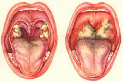 острый фарингит