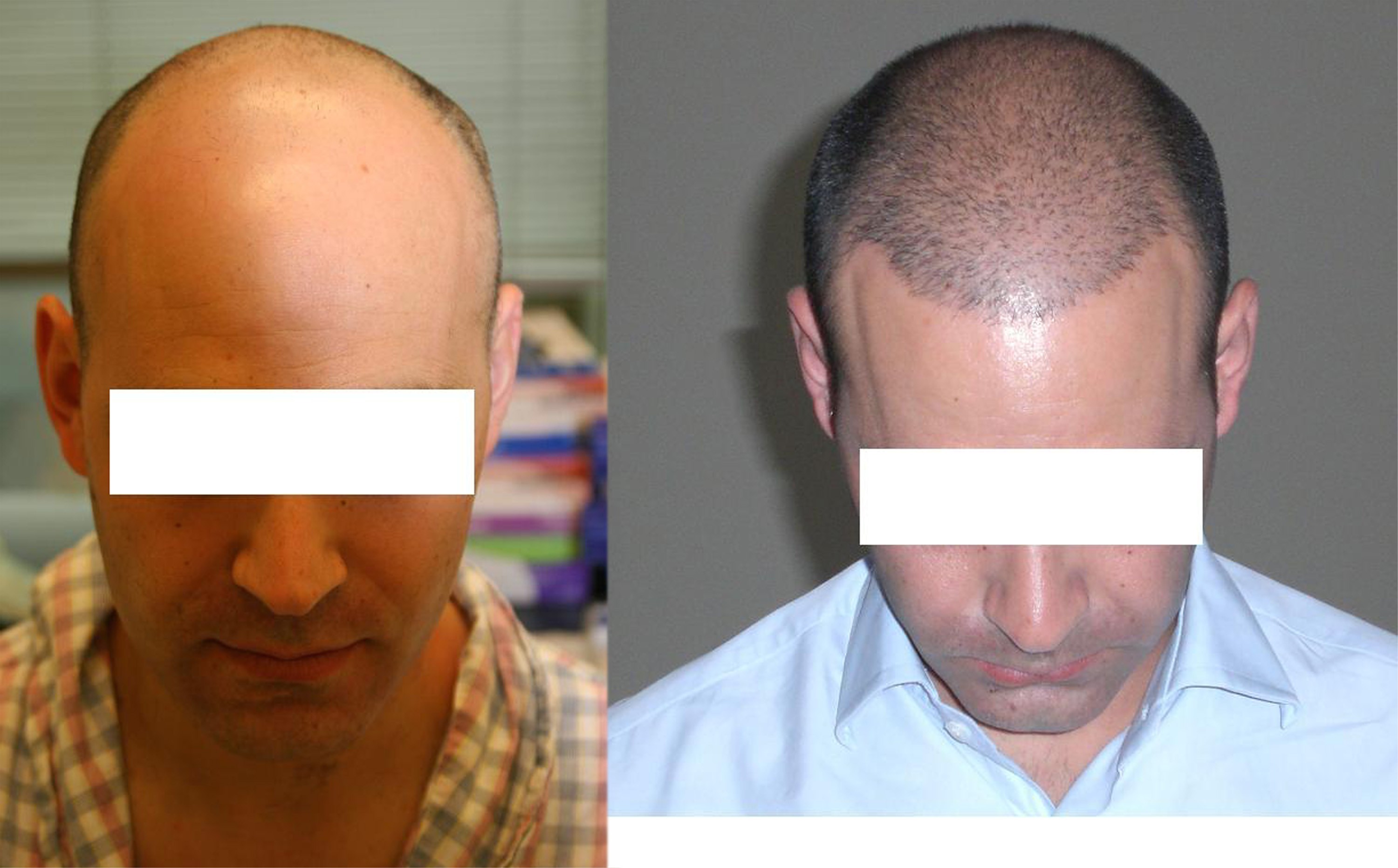 Центр пересадки волос. Реал транс Хаер до и после. До и после пересадки волос. Трансплантация волос с затылка. Голова до и после пересадки волос.