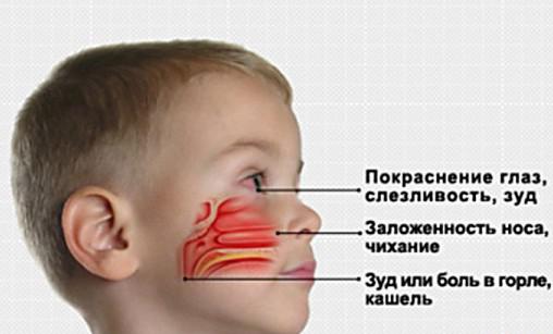 вазомоторный ринит у ребёнка