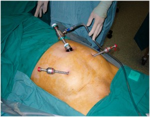 34-laparoskopicheskaya-operaciya-pri-varikocele