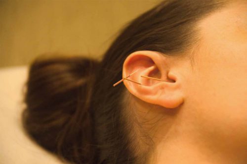 иглорефлексотерапия для ушей