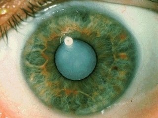 Осложнения катаракты