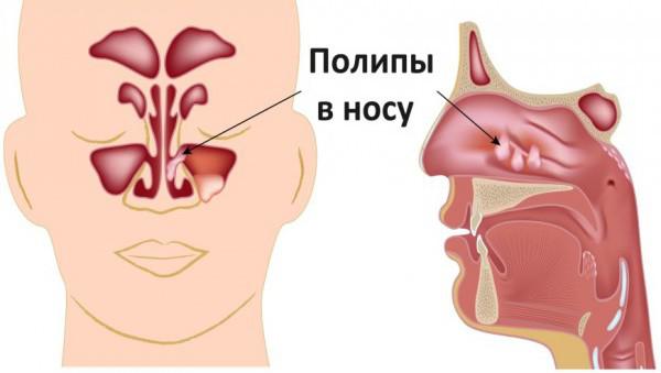 полипы в носу симптомы и лечение