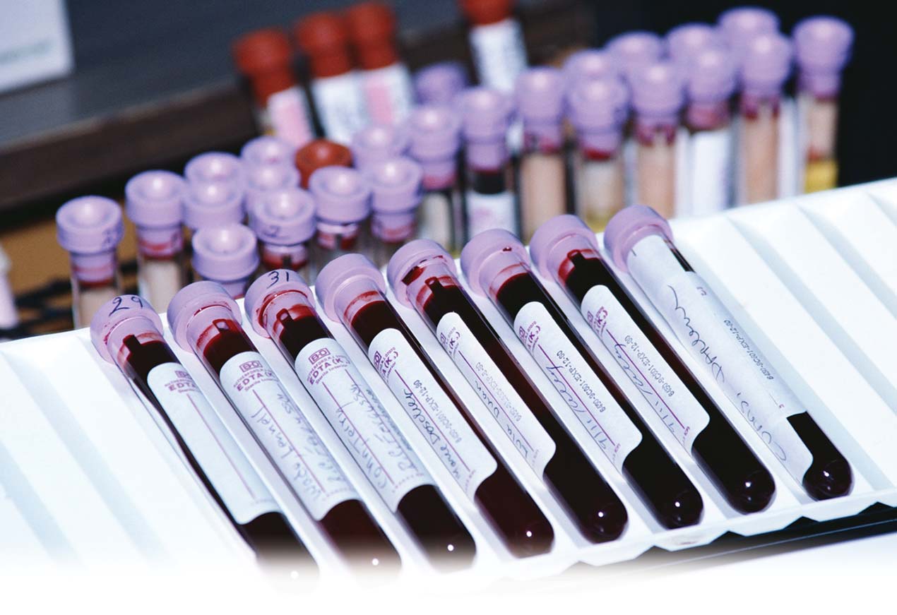 Здача крові на ПСА: суть аналізу і підготовка