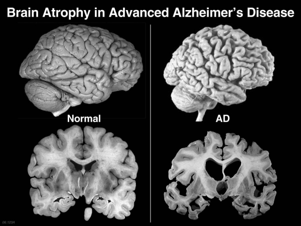 Хвороба Альцгеймера