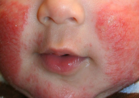 Атопический дерматит у детей, фото