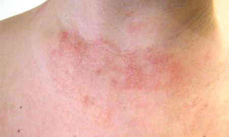 Атопический дерматит на шее и груди, фото
