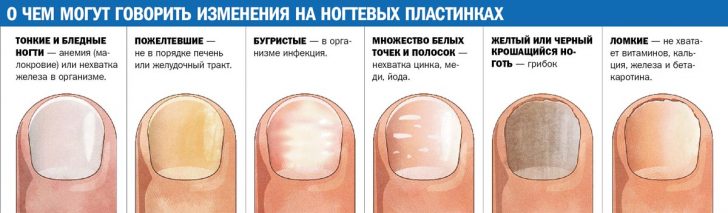 Характерные внешние изменения ногтей
