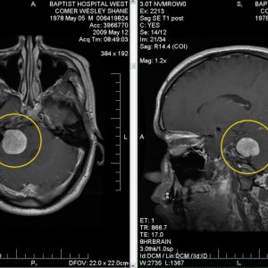 Brain-Tumor-2