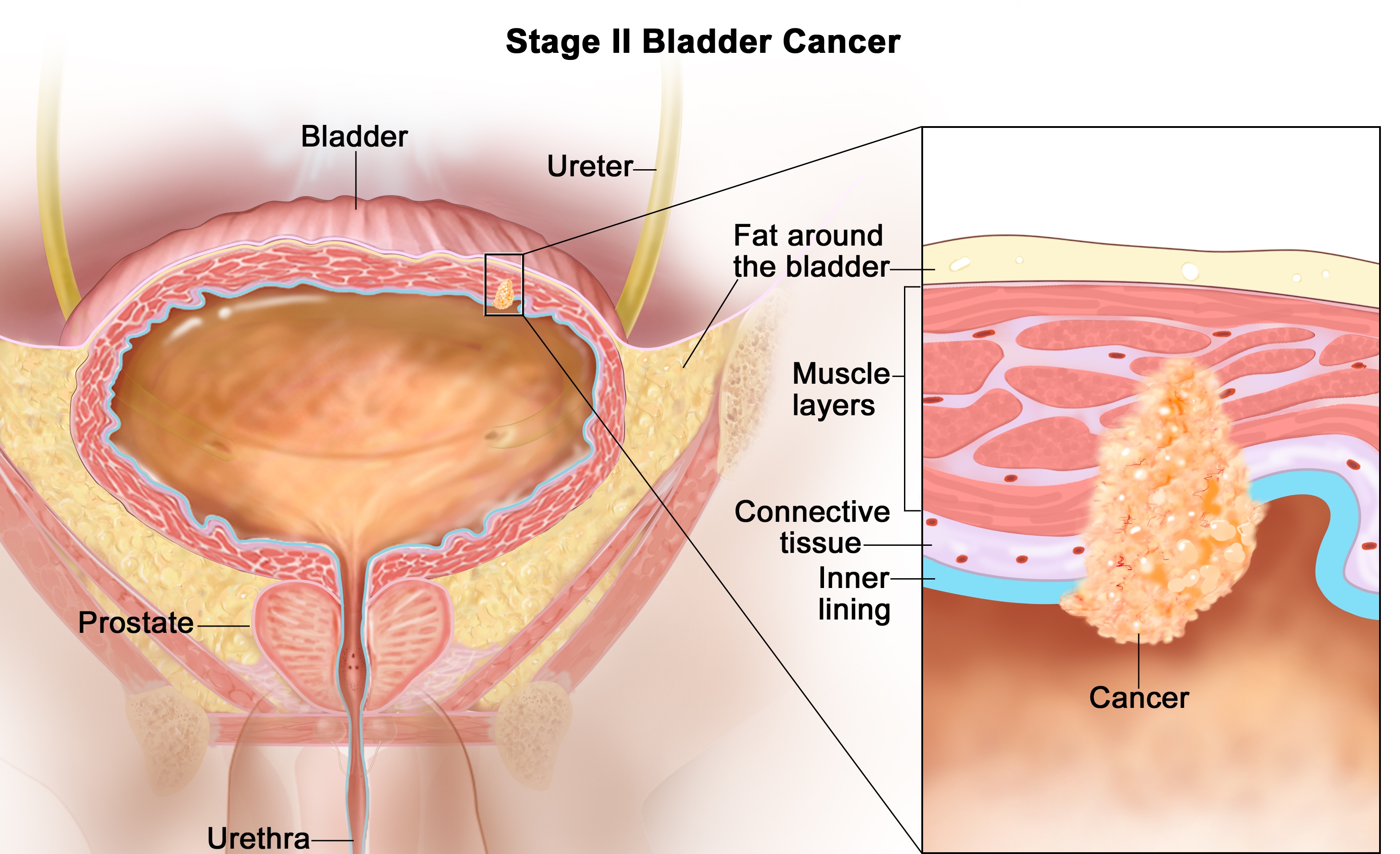 Лечение рака мочевого пузыря у мужчин