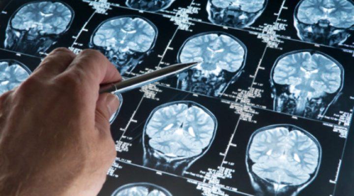 Кавернома головного мозга: причины, симптомы, лечение