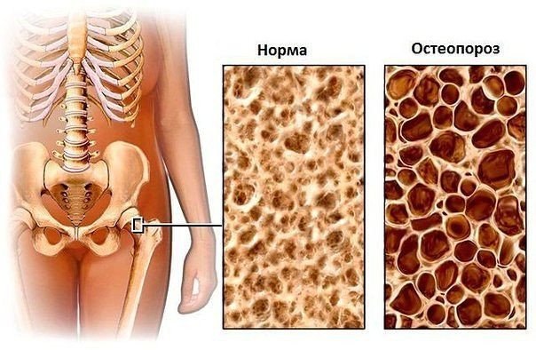 Причины развития остеопороза