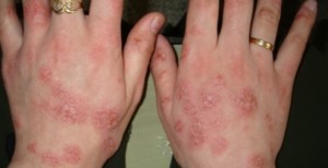 Наиболее частым заболеванием кожного покрова на лице и кистях рук является экзема хроническая