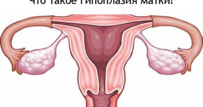 Гипоплазия матки, что это такое? — Степени, лечение и беременность