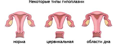 Гипоплазия матки по степеням
