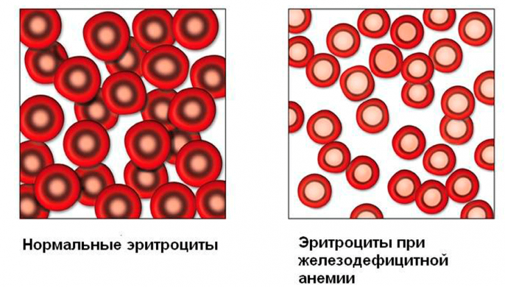 Причины низкого гемоглобина