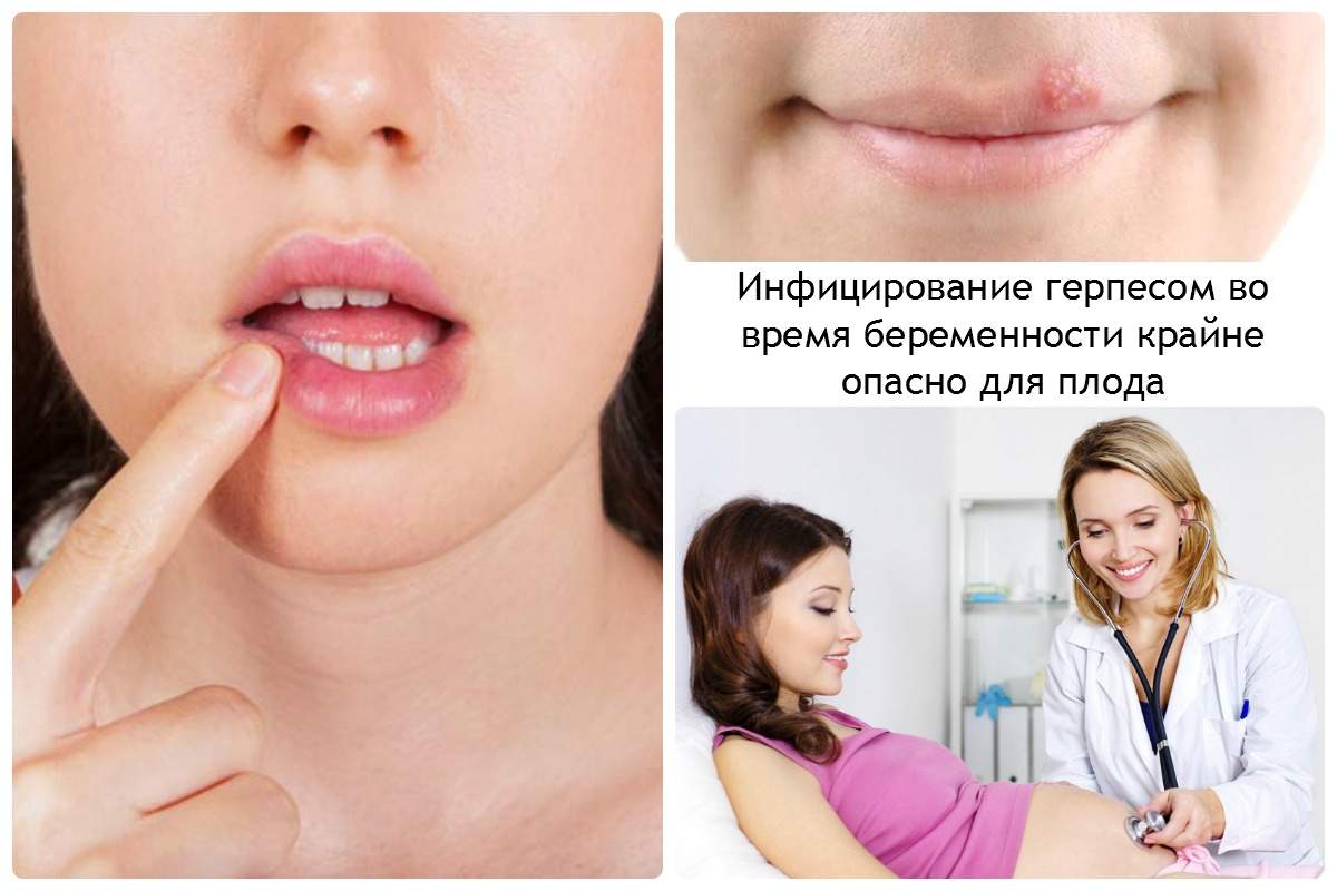 Infitsirovanie-gerpesom-vo-vremya-beremennosti-krayne-opasno-dlya-ploda