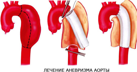 Лечение аневризма аорты