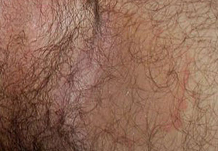 Лечение пахового эпидермофития у мужчин, фото паховой области
