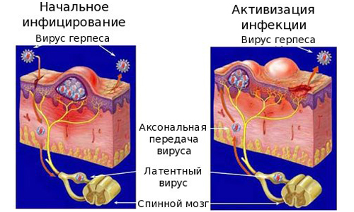 Mehanizm-zarazhenija-virusom-gerpesa