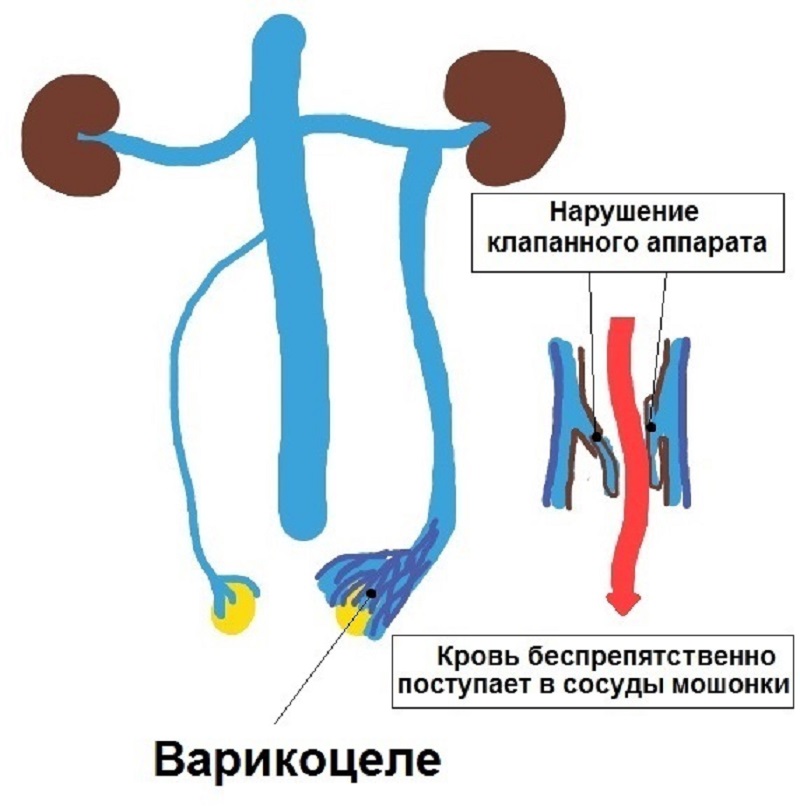 Методика Іваніссевіча - перевірений спосіб лікування варикоцеле