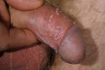 Papillom-infekciya-6