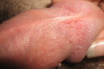 Papillom-infekciya-8