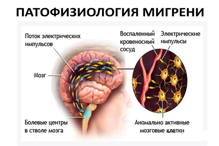 Patofiziologija-migreni