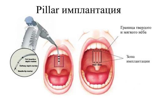 Pillar-implantatsiya