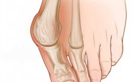 Почему болит косточка на ноге около большого пальца
