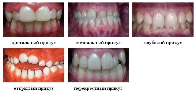 Pravilnyiy-prikus-zubov