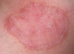 Причины микоза кожи