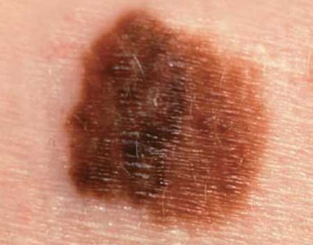 Рак кожи фото начальная стадия