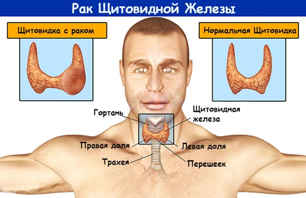 симптомы рака щитовидной железы