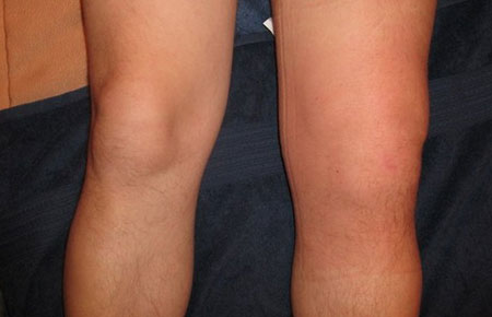 Симптомы синовита коленного сустава