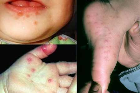 Симптомы вируса Коксаки у детей
