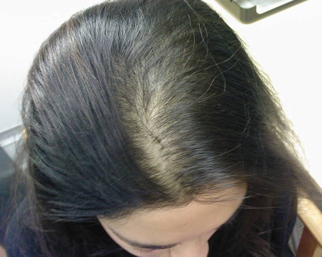 Телогеновое выпадение волос