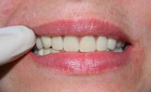 В основном пациенты положительно отзываются о  съемных зубных протезах