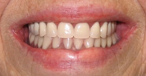Зубные протезы способны вернуть человеку ослепительную улыбку