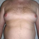 Уплотнение в груди у мужчин