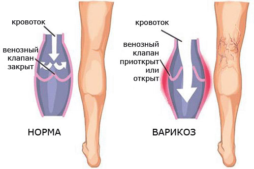 Варикозное расширение вен на ногах