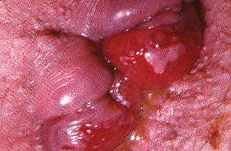 Воспаление геморроидального узла