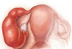 Воспаление яичников и беременность
