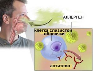 аллергия и синусопатия